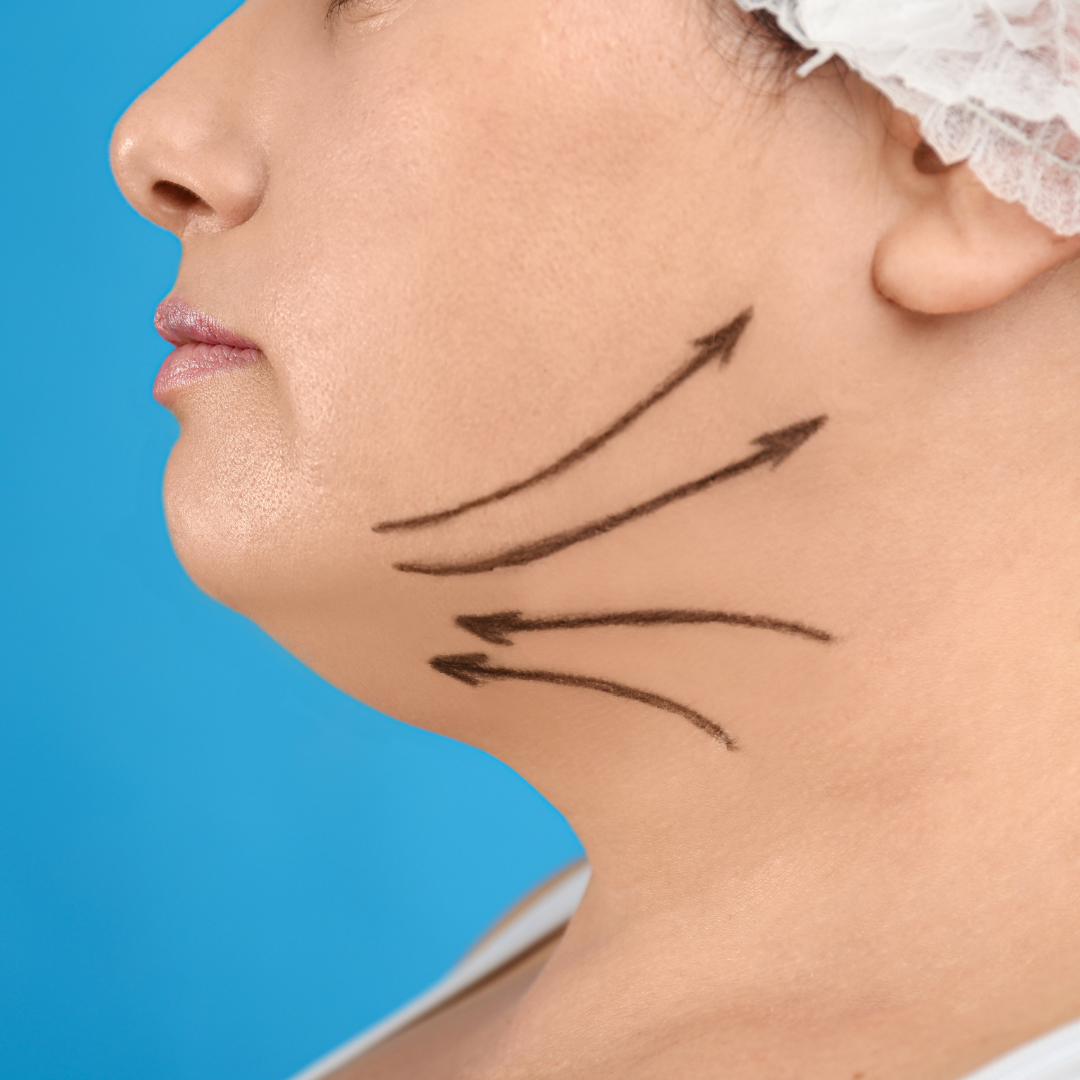 Reduces Double Chin